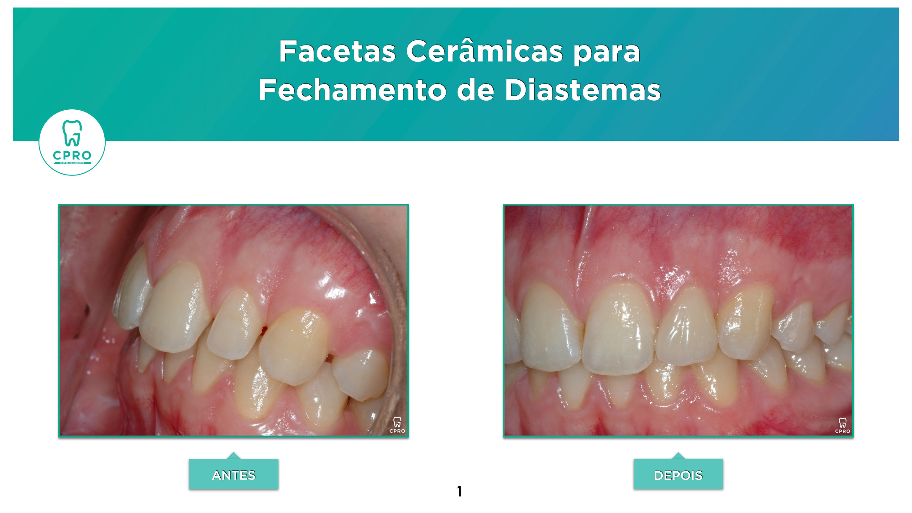 Facetas Cerâmicas para Fechamento de Diastemas